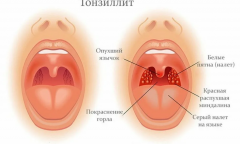 Воспаленные миндалины (тонзиллит): Виды тонзиллита